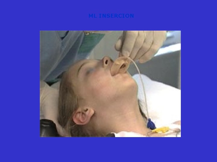 ML INSERCION 