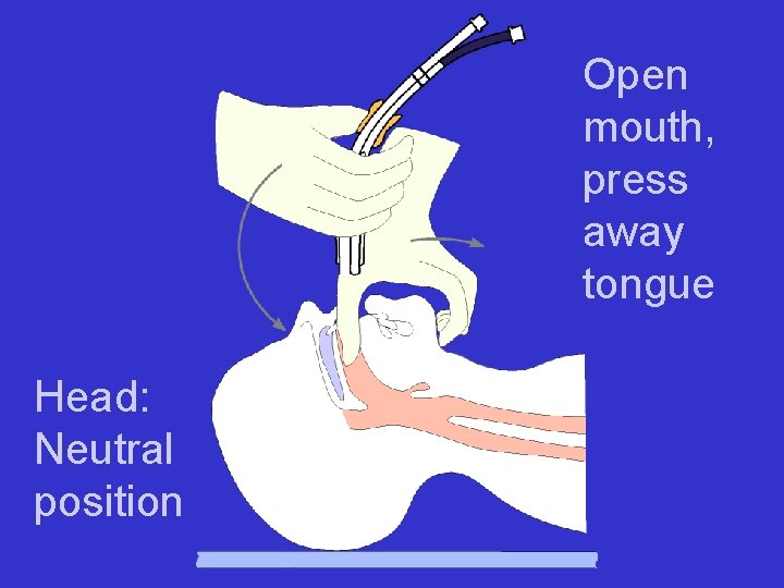 Open mouth, press away tongue Head: Neutral position 