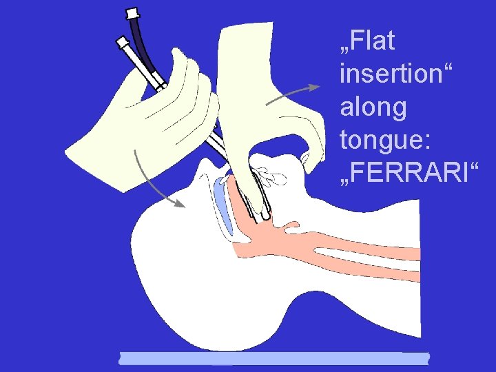 „Flat insertion“ along tongue: „FERRARI“ 