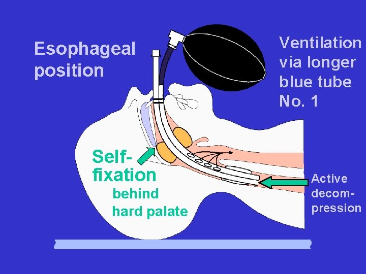 Esophageal position Selffixation behind hard palate Ventilation via longer blue tube No. 1 Active