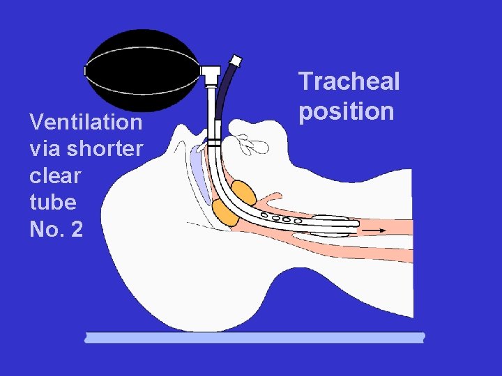 Ventilation via shorter clear tube No. 2 Tracheal position 