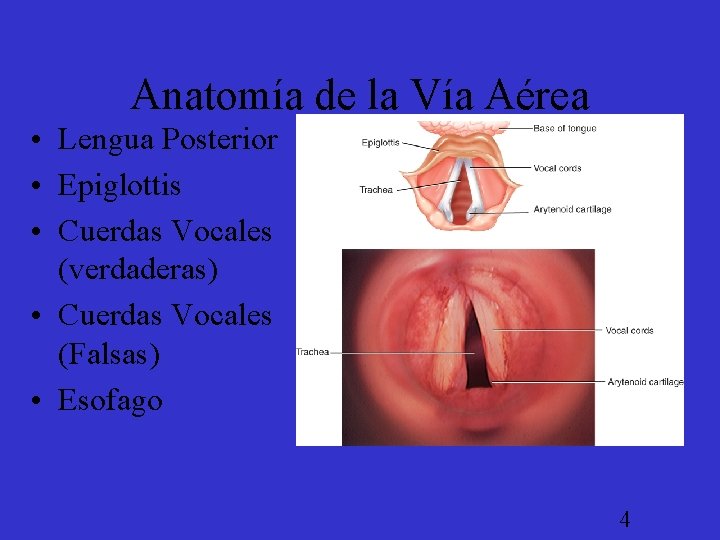 Anatomía de la Vía Aérea • Lengua Posterior • Epiglottis • Cuerdas Vocales (verdaderas)