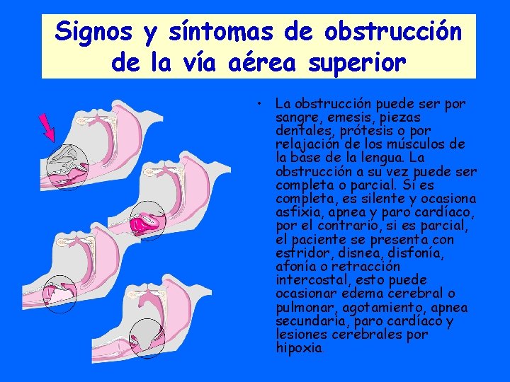 Signos y síntomas de obstrucción de la vía aérea superior • La obstrucción puede