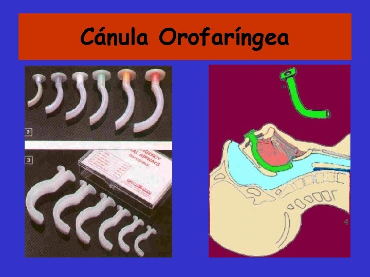 Cánula Orofaríngea 