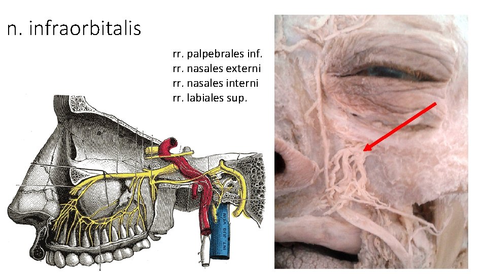 n. infraorbitalis rr. palpebrales inf. rr. nasales externi rr. nasales interni rr. labiales sup. n. infraorbitalis rr. palpebrales inf. rr. nasales externi rr. nasales interni rr. labiales sup.