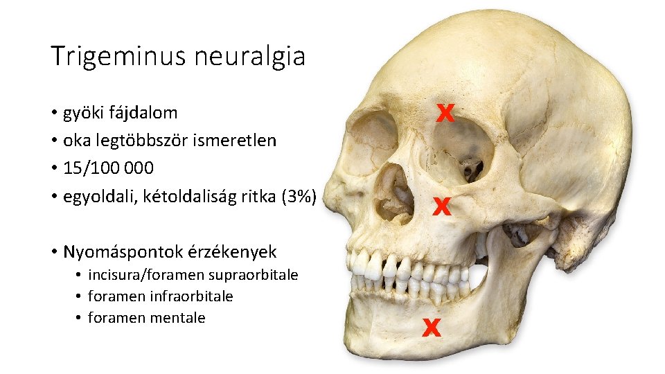 Trigeminus neuralgia • gyöki fájdalom • oka legtöbbször ismeretlen • 15/100 000 • egyoldali, Trigeminus neuralgia • gyöki fájdalom • oka legtöbbször ismeretlen • 15/100 000 • egyoldali,