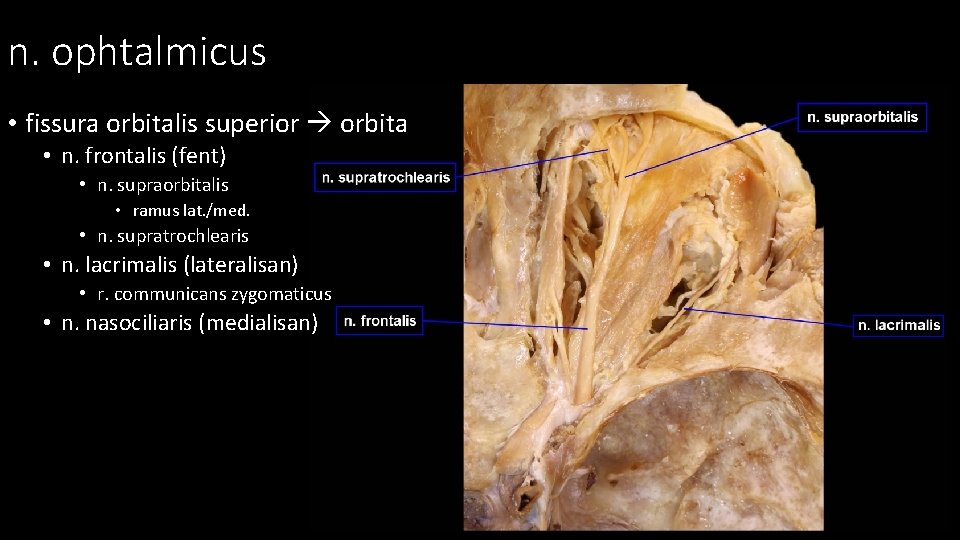 n. ophtalmicus • fissura orbitalis superior orbita • n. frontalis (fent) • n. supraorbitalis n. ophtalmicus • fissura orbitalis superior orbita • n. frontalis (fent) • n. supraorbitalis