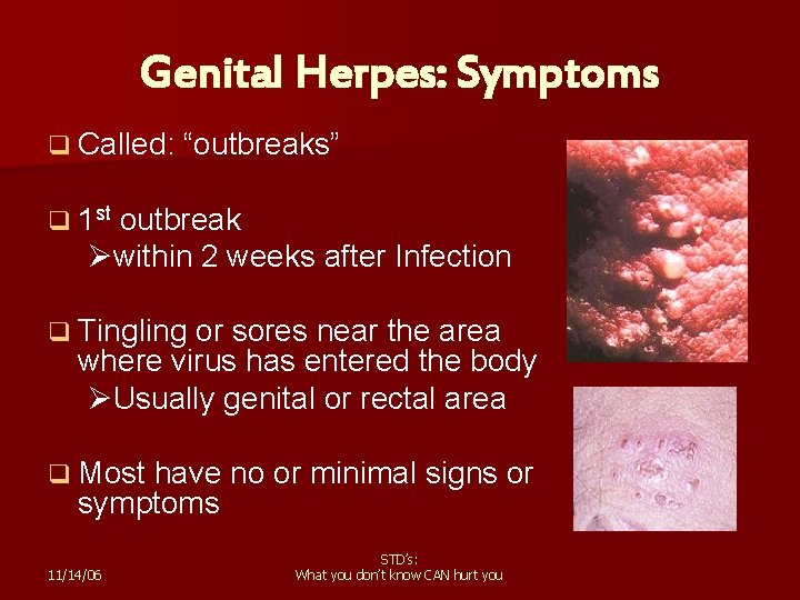 Genital Herpes: Symptoms q Called: “outbreaks” q 1 st outbreak Øwithin 2 weeks after