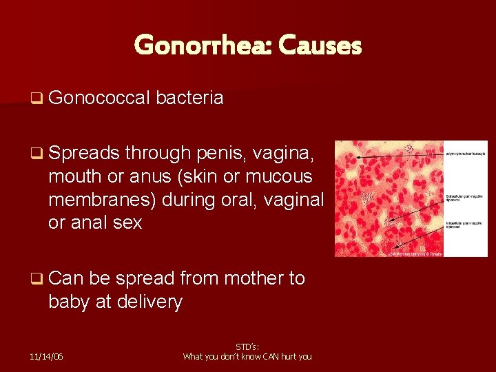 Gonorrhea: Causes q Gonococcal bacteria q Spreads through penis, vagina, mouth or anus (skin