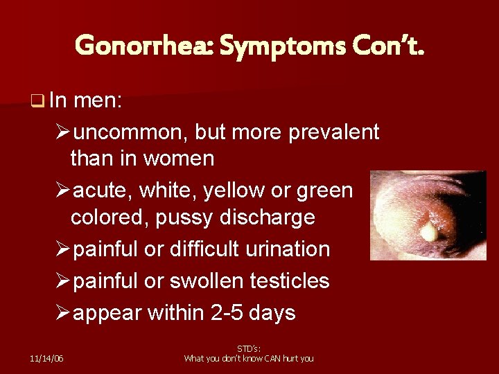 Gonorrhea: Symptoms Con’t. q In men: Øuncommon, but more prevalent than in women Øacute,