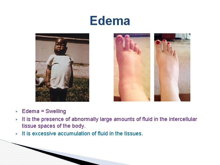 Edema ▶ ▶ ▶ Edema = Swelling It is the presence of abnormally large