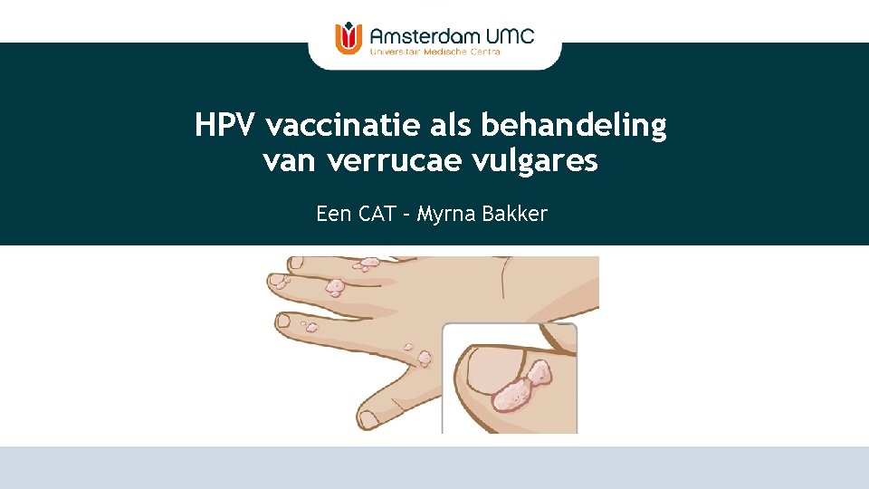 HPV vaccinatie als behandeling van verrucae vulgares Een CAT – Myrna Bakker 