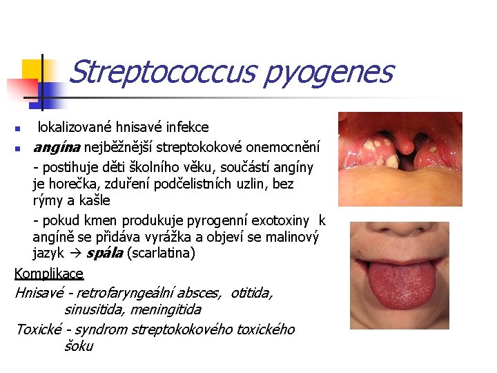 Streptococcus pyogenes lokalizované hnisavé infekce n angína nejběžnější streptokokové onemocnění - postihuje děti školního