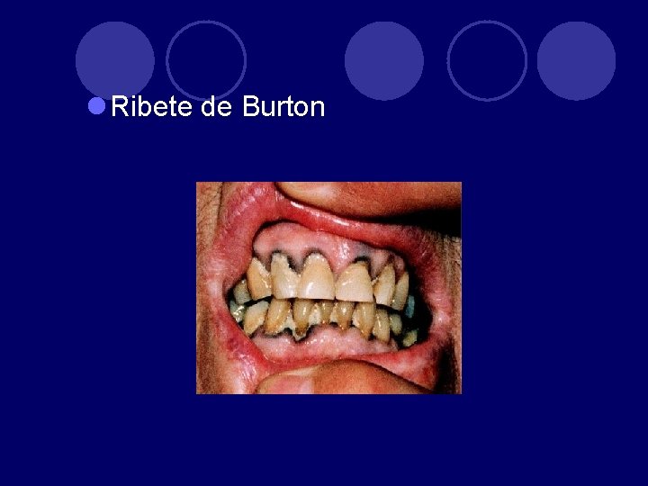 l Ribete de Burton 