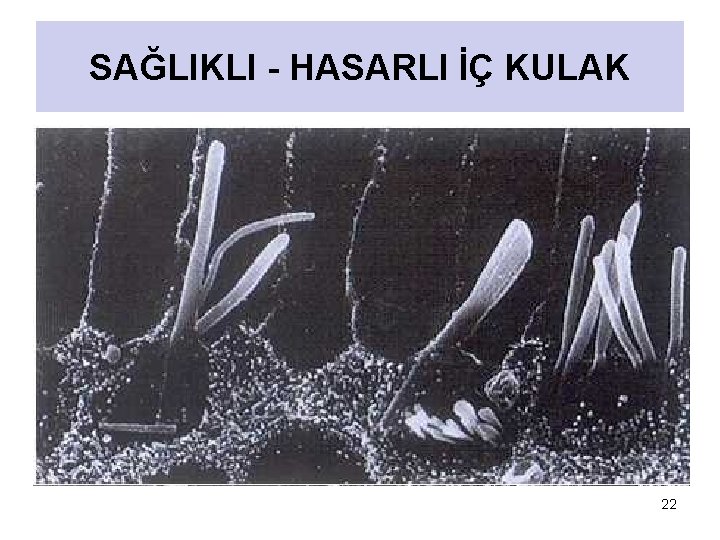 SAĞLIKLI - HASARLI İÇ KULAK 22 