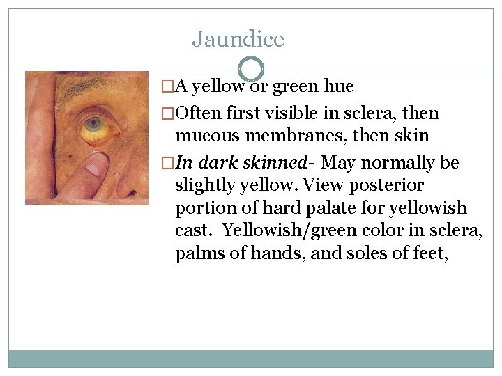 Jaundice �A yellow or green hue �Often first visible in sclera, then mucous membranes,
