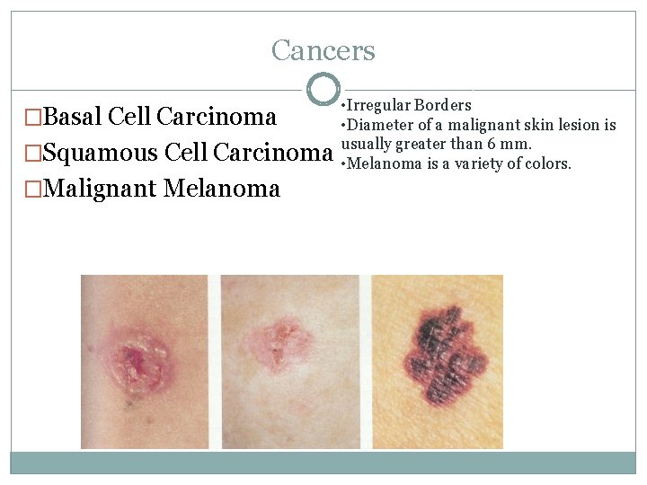 Cancers �Basal Cell Carcinoma �Squamous Cell Carcinoma �Malignant Melanoma • Irregular Borders • Diameter