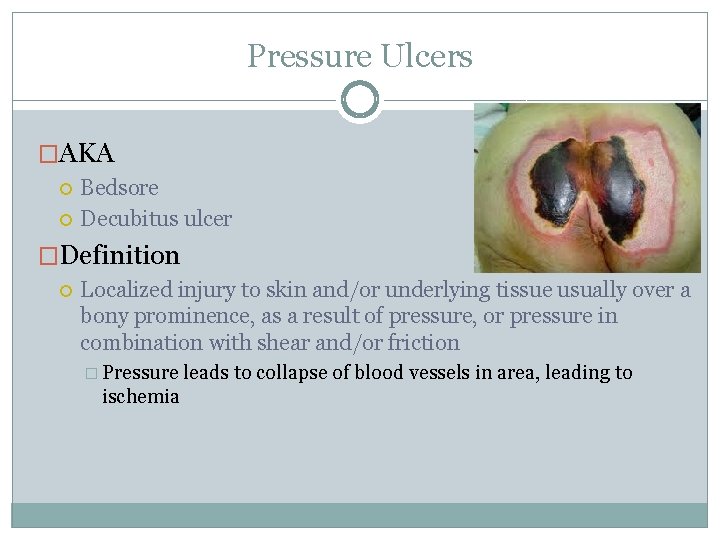 Pressure Ulcers �AKA Bedsore Decubitus ulcer �Definition Localized injury to skin and/or underlying tissue