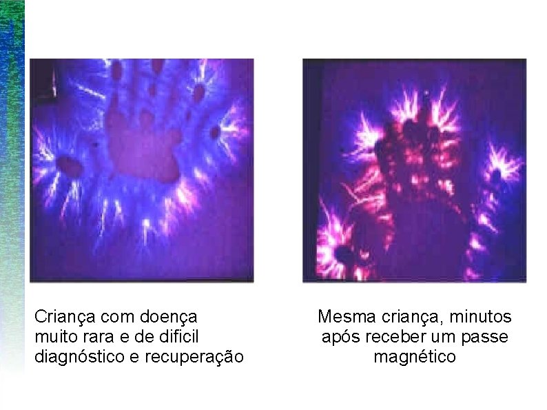 Criança com doença muito rara e de dificil diagnóstico e recuperação Mesma criança, minutos