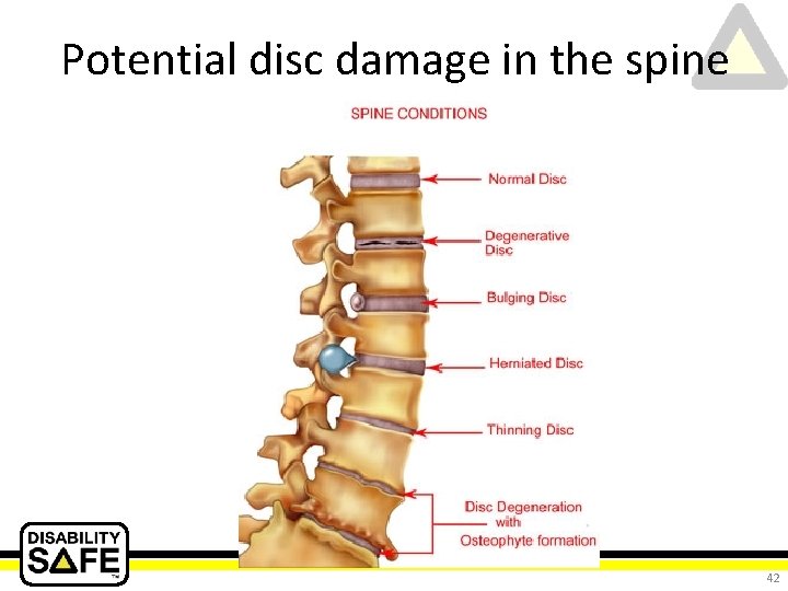 Potential disc damage in the spine 42 