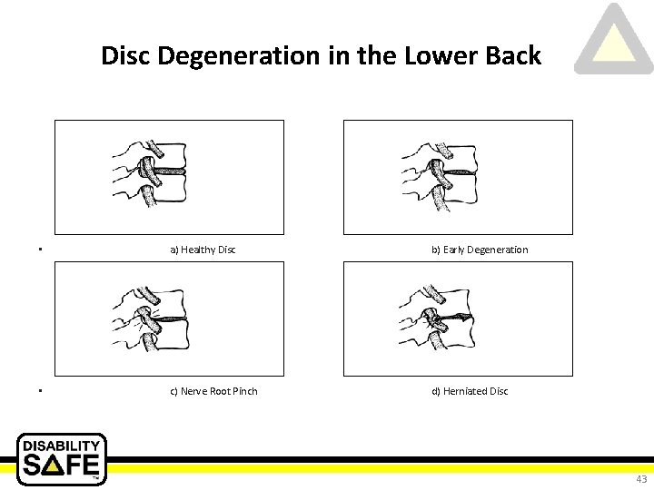 Disc Degeneration in the Lower Back • a) Healthy Disc b) Early Degeneration •