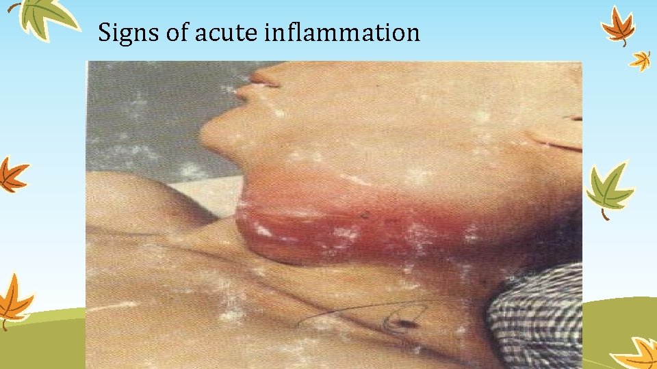 Signs of acute inflammation 
