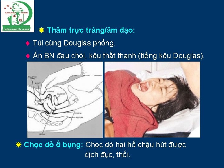  Thăm trực tràng/âm đạo: Túi cùng Douglas phồng. Ấn BN đau chói, kêu