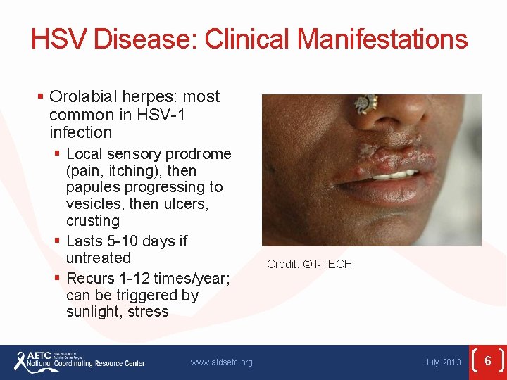 HSV Disease: Clinical Manifestations § Orolabial herpes: most common in HSV-1 infection § Local
