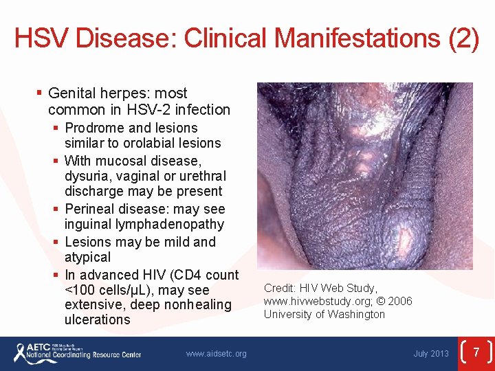 HSV Disease: Clinical Manifestations (2) § Genital herpes: most common in HSV-2 infection §