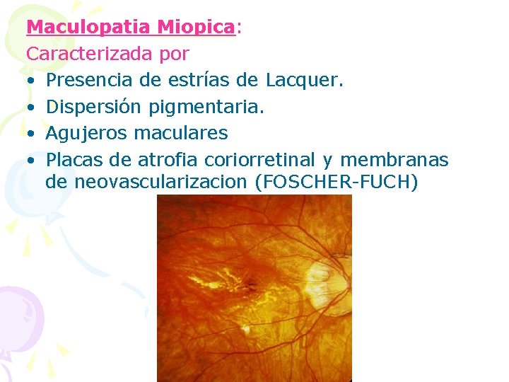 Maculopatia Miopica: Miopica Caracterizada por • Presencia de estrías de Lacquer. • Dispersión pigmentaria.