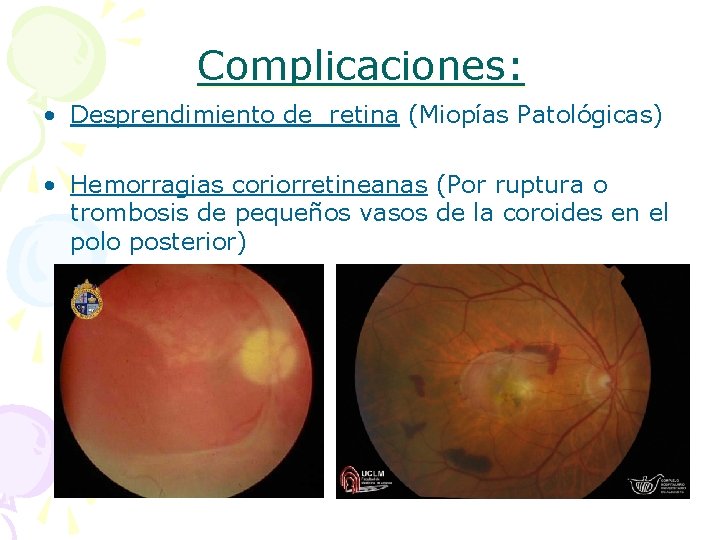 Complicaciones: • Desprendimiento de retina (Miopías Patológicas) • Hemorragias coriorretineanas (Por ruptura o trombosis