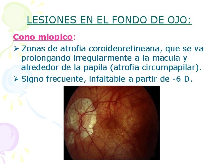 LESIONES EN EL FONDO DE OJO: Cono miopico: Ø Zonas de atrofia coroideoretineana, que