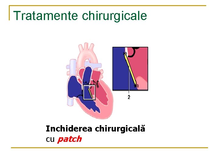 Tratamente chirurgicale Inchiderea chirurgicală cu patch Tratamente chirurgicale Inchiderea chirurgicală cu patch