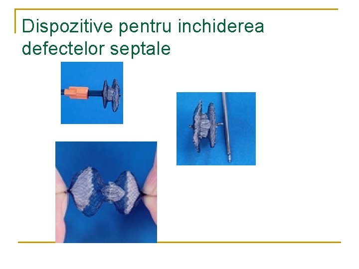 Dispozitive pentru inchiderea defectelor septale Dispozitive pentru inchiderea defectelor septale