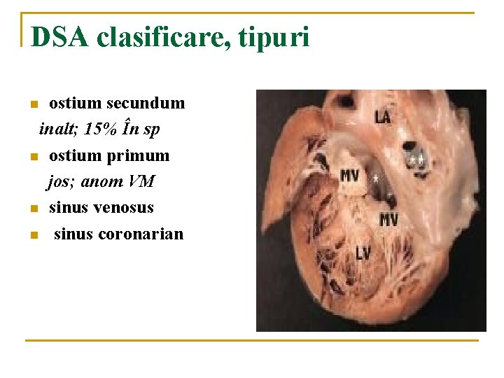 DSA clasificare, tipuri ostium secundum inalt; 15% În sp n ostium primum jos; anom DSA clasificare, tipuri ostium secundum inalt; 15% În sp n ostium primum jos; anom