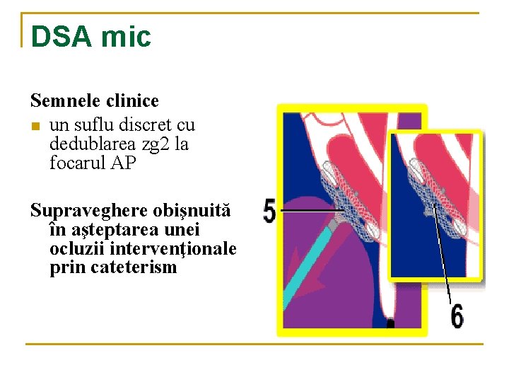 DSA mic Semnele clinice n un suflu discret cu dedublarea zg 2 la focarul DSA mic Semnele clinice n un suflu discret cu dedublarea zg 2 la focarul