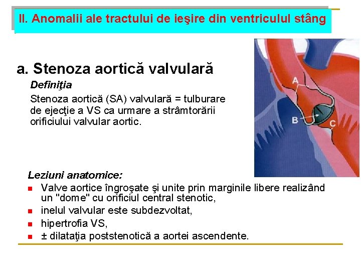 II. Anomalii ale tractului de ieşire din ventriculul stâng a. Stenoza aortică valvulară Definiţia II. Anomalii ale tractului de ieşire din ventriculul stâng a. Stenoza aortică valvulară Definiţia