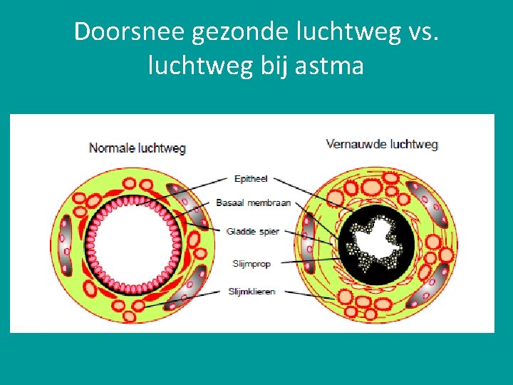 Doorsnee gezonde luchtweg vs. luchtweg bij astma 