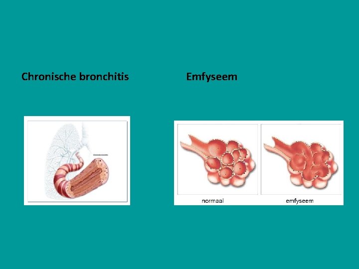 Chronische bronchitis Emfyseem 