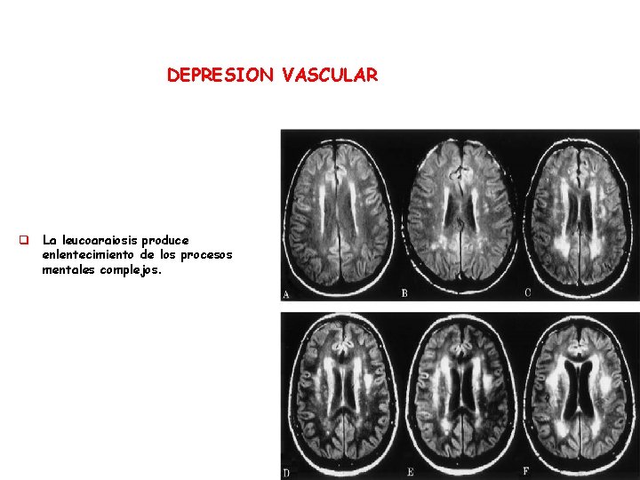 DEPRESION VASCULAR q La leucoaraiosis produce enlentecimiento de los procesos mentales complejos. 