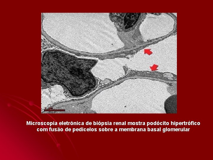 Microscopia eletrônica de biópsia renal mostra podócito hipertrófico com fusão de pedicelos sobre Microscopia eletrônica de biópsia renal mostra podócito hipertrófico com fusão de pedicelos sobre