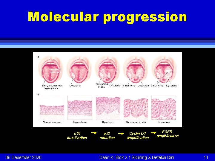 Molecular progression p 16 inactivation p 53 mutation Cyclin D 1 amplification EGFR amplification