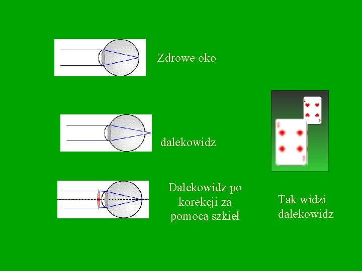 Zdrowe oko dalekowidz Dalekowidz po korekcji za pomocą szkieł Tak widzi dalekowidz 