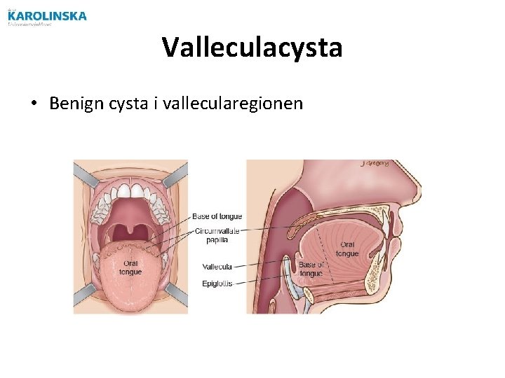 Valleculacysta • Benign cysta i vallecularegionen Valleculacysta • Benign cysta i vallecularegionen