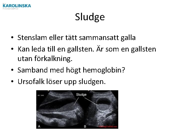 Sludge • Stenslam eller tätt sammansatt galla • Kan leda till en gallsten. Är Sludge • Stenslam eller tätt sammansatt galla • Kan leda till en gallsten. Är