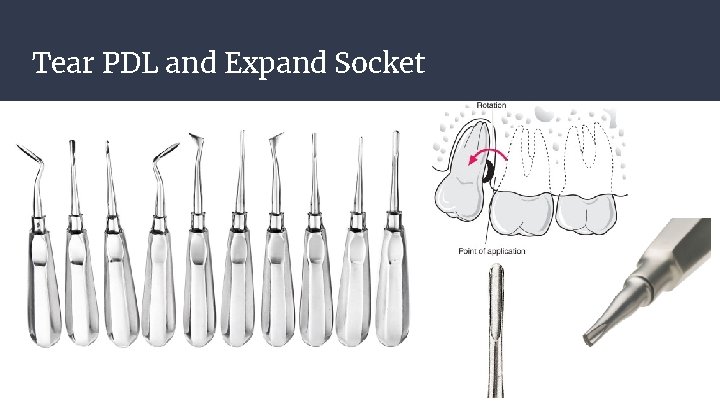 Tear PDL and Expand Socket Tear PDL and Expand Socket