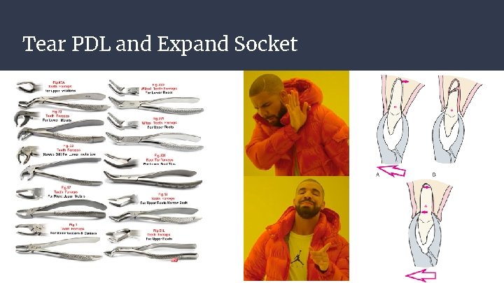 Tear PDL and Expand Socket Tear PDL and Expand Socket