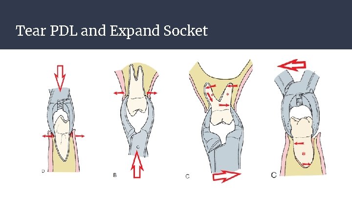 Tear PDL and Expand Socket Tear PDL and Expand Socket