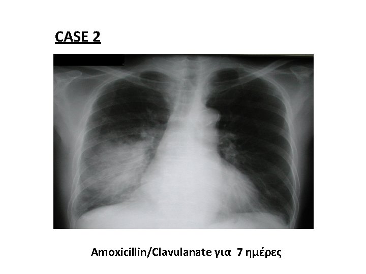CASE 2 Amoxicillin/Clavulanate για 7 ημέρες 