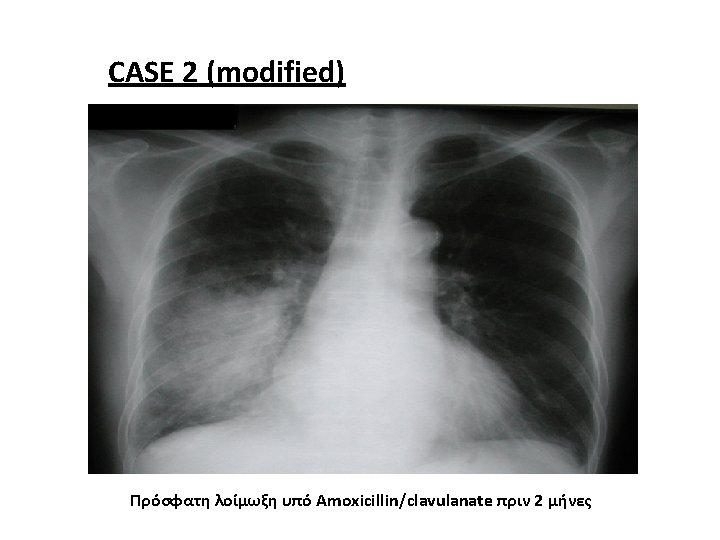 CASE 2 (modified) Πρόσφατη λοίμωξη υπό Amoxicillin/clavulanate πριν 2 μήνες 